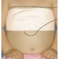 Pediatric Catheter Wrap CathWrap