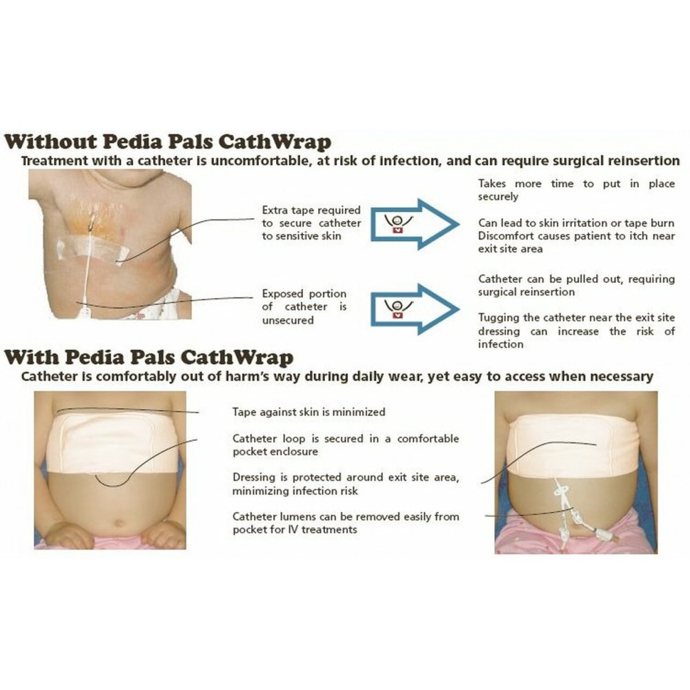 Pediatric Catheter Wrap CathWrap