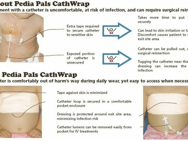 Pediatric Catheter Wrap CathWrap